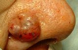 skin cancer
